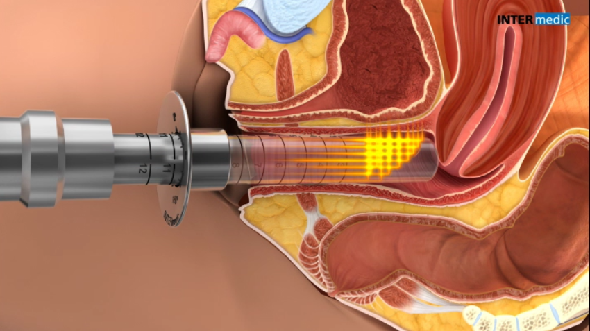 Gynelase 2 CO2 laser Accion GYNELASE en mucosa vaginal